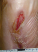 Week 16 wound area: 1.2 cm²