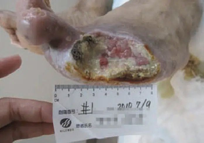 Diabetic Amputation Sakata - Diabetic Amputation Sakata - July 9