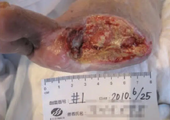 Diabetic Amputation Sakata - June 25