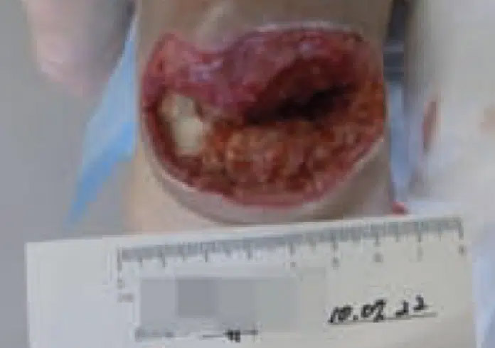 Diabetic Amputation Sakata - July 22