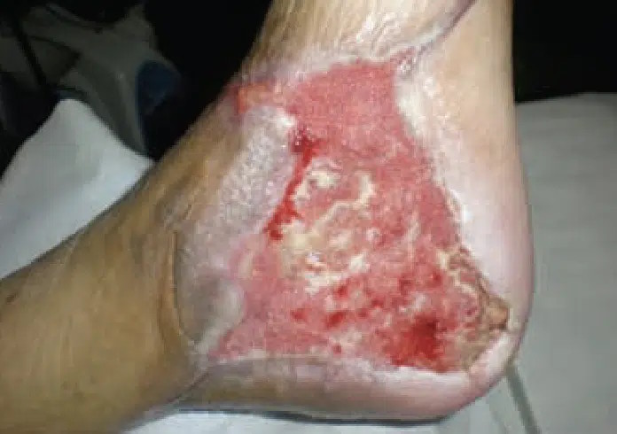 Diabetic Amputation Sakata - July 7