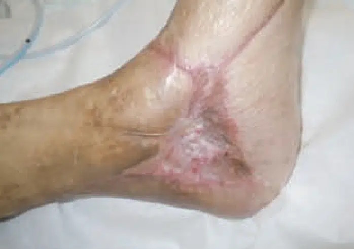 Diabetic Amputation Sakata - November 4